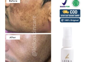 cara menghilangkan flek hitam di wajah yang membandel_15cf28592.jpg