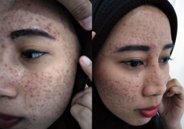 harga perawatan di jasper_9faca1db3.jpg