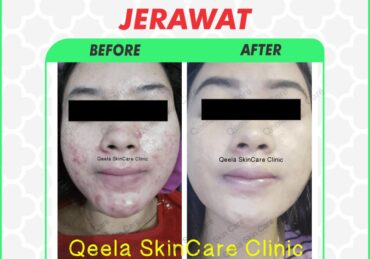 harga perawatan di qeela skin care_245ef5b95.jpg